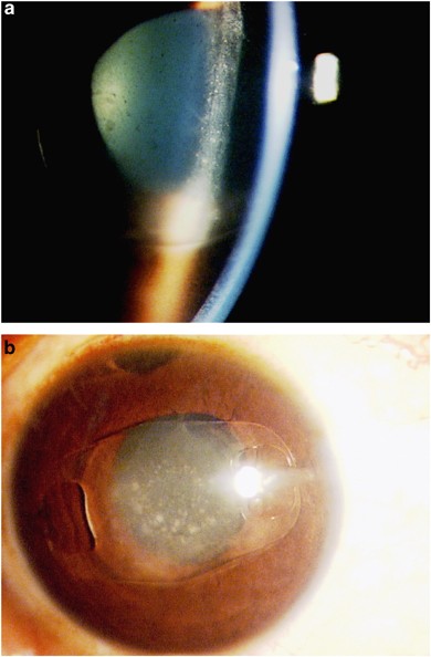 Severe inflammation following iris fixated anterior chamber phakic  intraocular lens for myopia | Eye