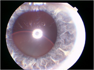 The Subluxated Lens A Patient S Perspective Eye