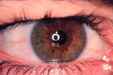 How red is a white eye? Clinical grading of normal conjunctival hyperaemia  | Eye
