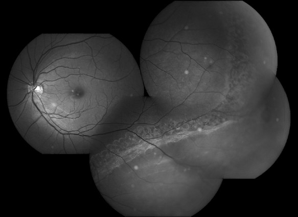 Barrage laser photocoagulation for macula-sparing asymptomatic clinical  rhegmatogenous retinal detachments | Eye