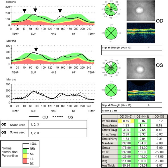 what is tobacco amblyopia Optical coherence tomography in a patient with tobacco-alcohol amblyopia