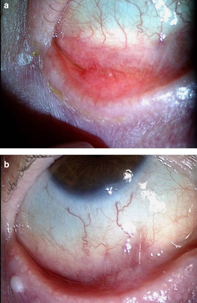 Successful biologic treatment of ocular mucous membrane pemphigoid with  anti-TNF-α | Eye