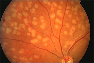 Pain response and follow-up of patients undergoing panretinal laser  photocoagulation with reduced exposure times | Eye