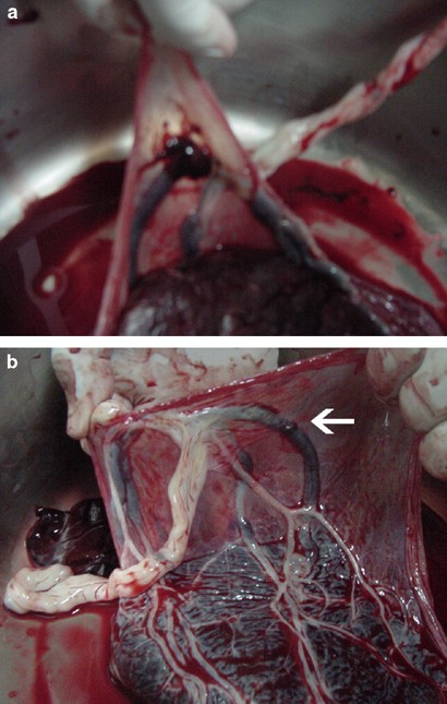 Ruptured vasa previa in velamentous cord insertion placenta | Journal of  Perinatology