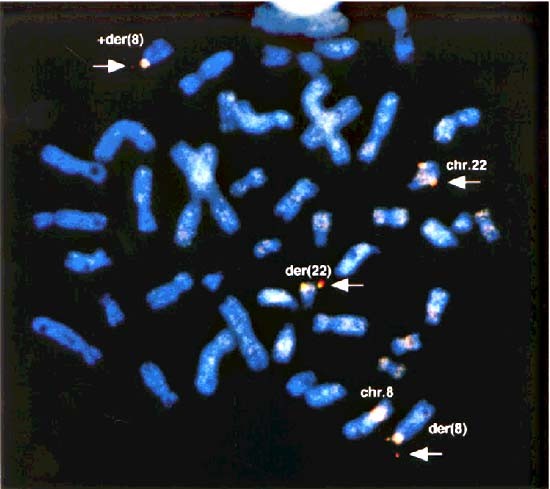 Fusion Of Moz And P300 Histone Acetyltransferases In Acute Monocytic Leukemia With A T 8 22 P11 Q13 Chromosome Translocation Leukemia Fusion Of Moz And P300 Histone Acetyltransferases In Acute Monocytic Leukemia With A T 8 22 P11 Q13 Chromosome Translocation Leukemia