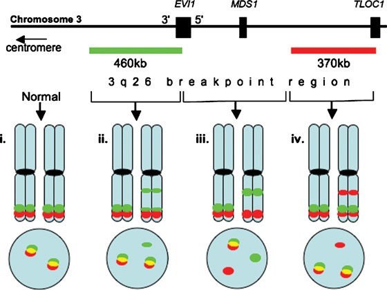 A simple FISH assay for the detection of 3q26 rearrangements in myeloid  malignancy | Leukemia