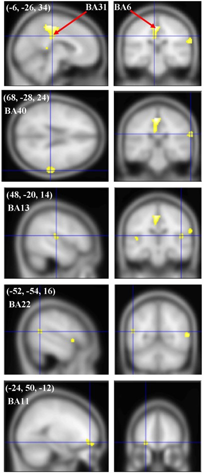 Levodopa Challenge Neuroimaging Of Levodopa Related Mood