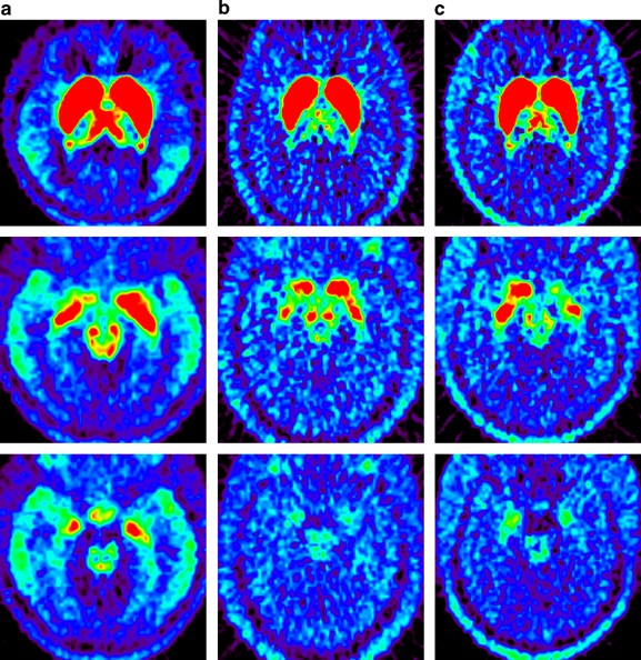 Occupancy Of Striatal And Extrastriatal Dopamine D 2 Receptors By