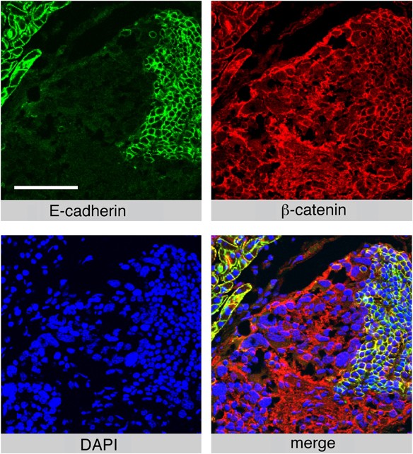 Tumor Progression Induced By The Loss Of E Cadherin Independent Of B Catenin Tcf Mediated Wnt Signaling Oncogene