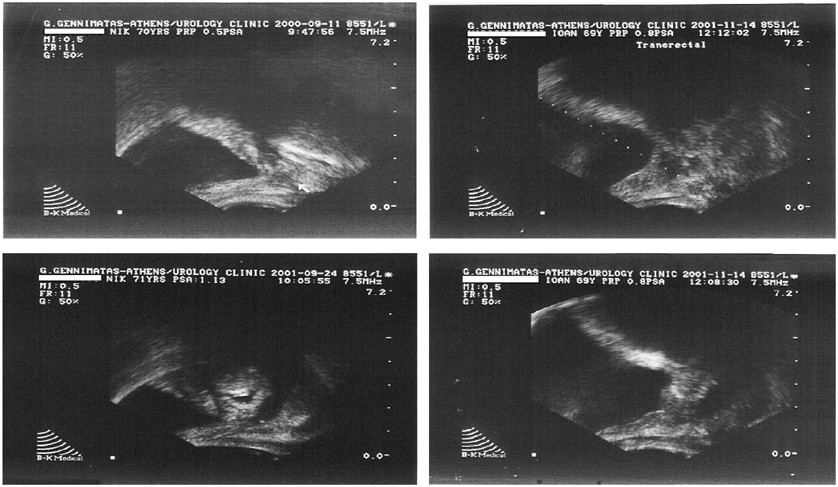 Postradical Prostatectomy Trus Guided Anastomotic Biopsy Where Do We Stand Today Prostate Cancer And Prostatic Diseases