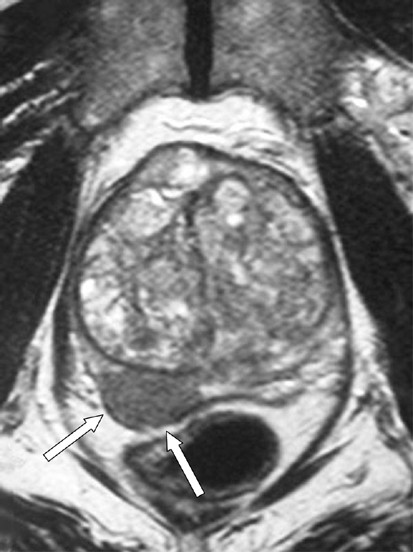 does prostatitis show up on mri