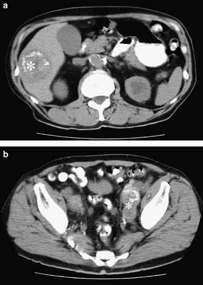 prostate calcifications psa