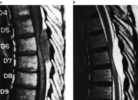 Spinal Epidural Cavernous Haemangioma A Case Report And Review Of Literature Spinal Cord