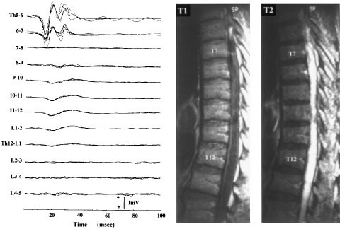 Motor Evoked Potentials Elicited From Erector Spinae Muscles In Patients With Thoracic Myelopathy Spinal Cord