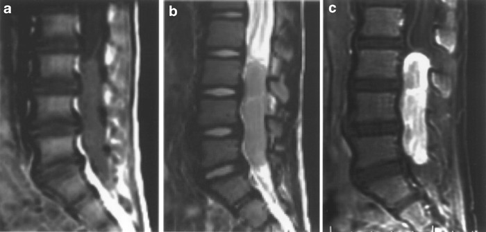 Primary malignant peripheral nerve sheath tumor of the cauda equina in a  child case report