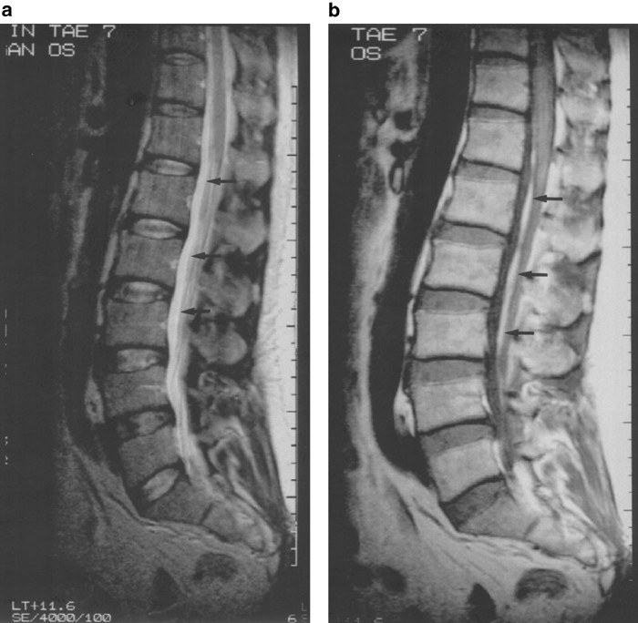 Idiopathic spontaneous spinal subarachnoid hemorrhage | Spinal Cord