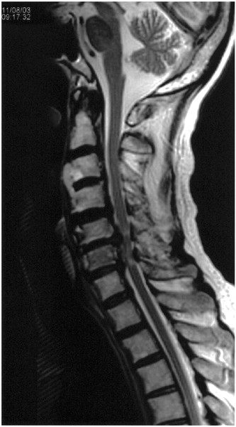 Brachial diplegia as a result of cervical cord injury | Spinal Cord
