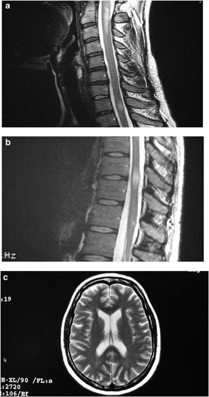 Clinical characteristics, course and prognosis of spinal multiple sclerosis  | Spinal Cord