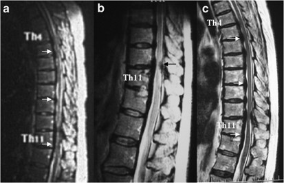 Hypertrophy of the posterior longitudinal ligament in the thoracic spine | Spinal  Cord