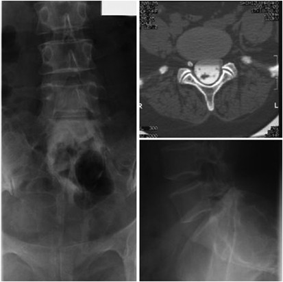 Adult onset tethered cord syndrome associated with intradural dermoid cyst.  A case report | Spinal Cord