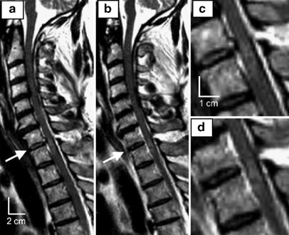 Subacute human spinal cord contusion: few lymphocytes and many macrophages  | Spinal Cord