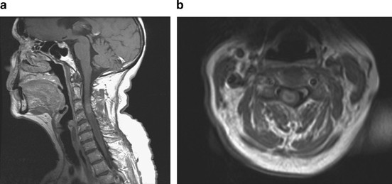 Intramedullary spinal cord tumor presenting as the initial manifestation of  metastatic colon cancer: case report and review of the literature | Spinal  Cord