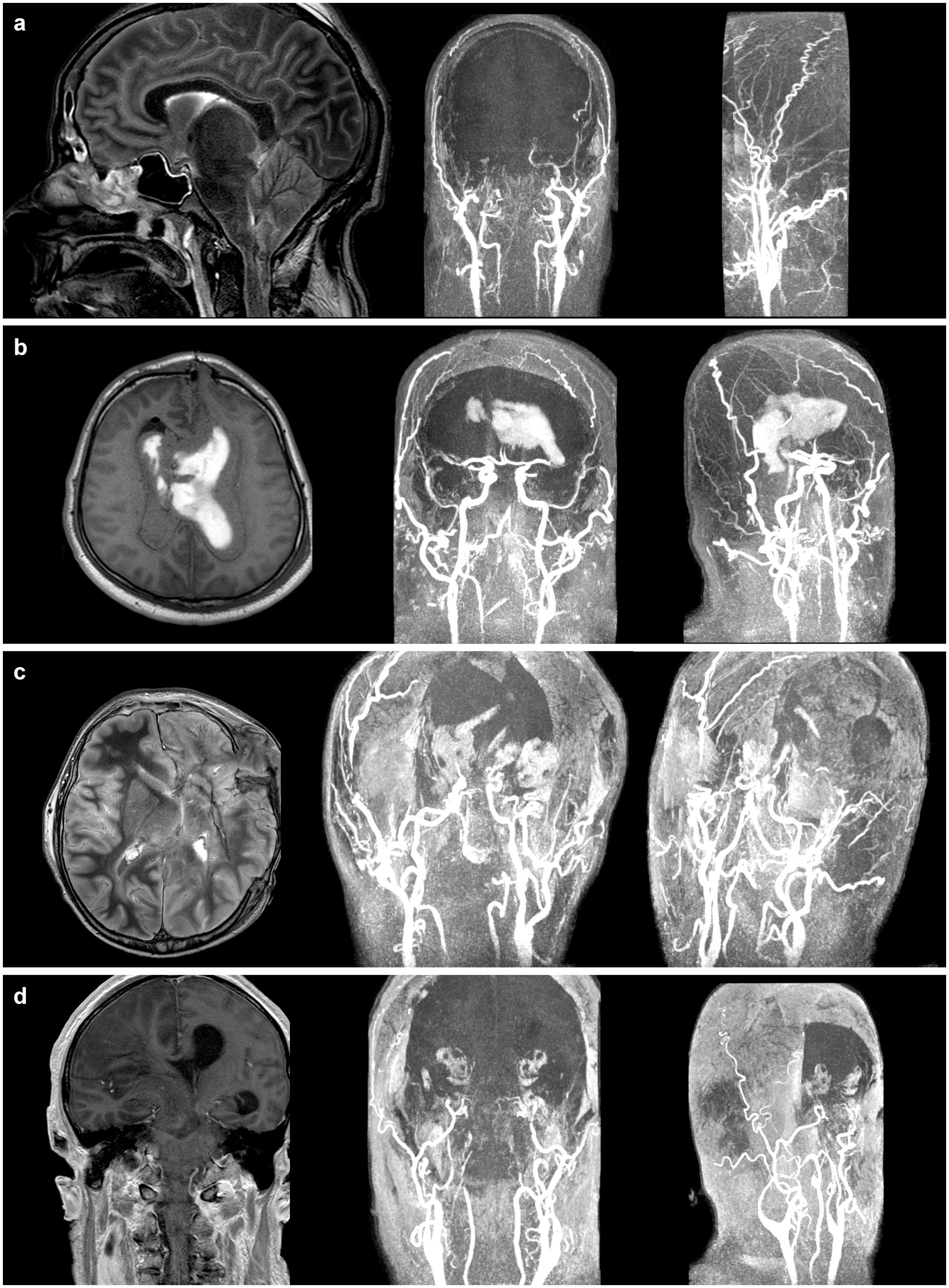 Gadolinium-enhanced magnetic resonance angiography in brain death |  Scientific Reports