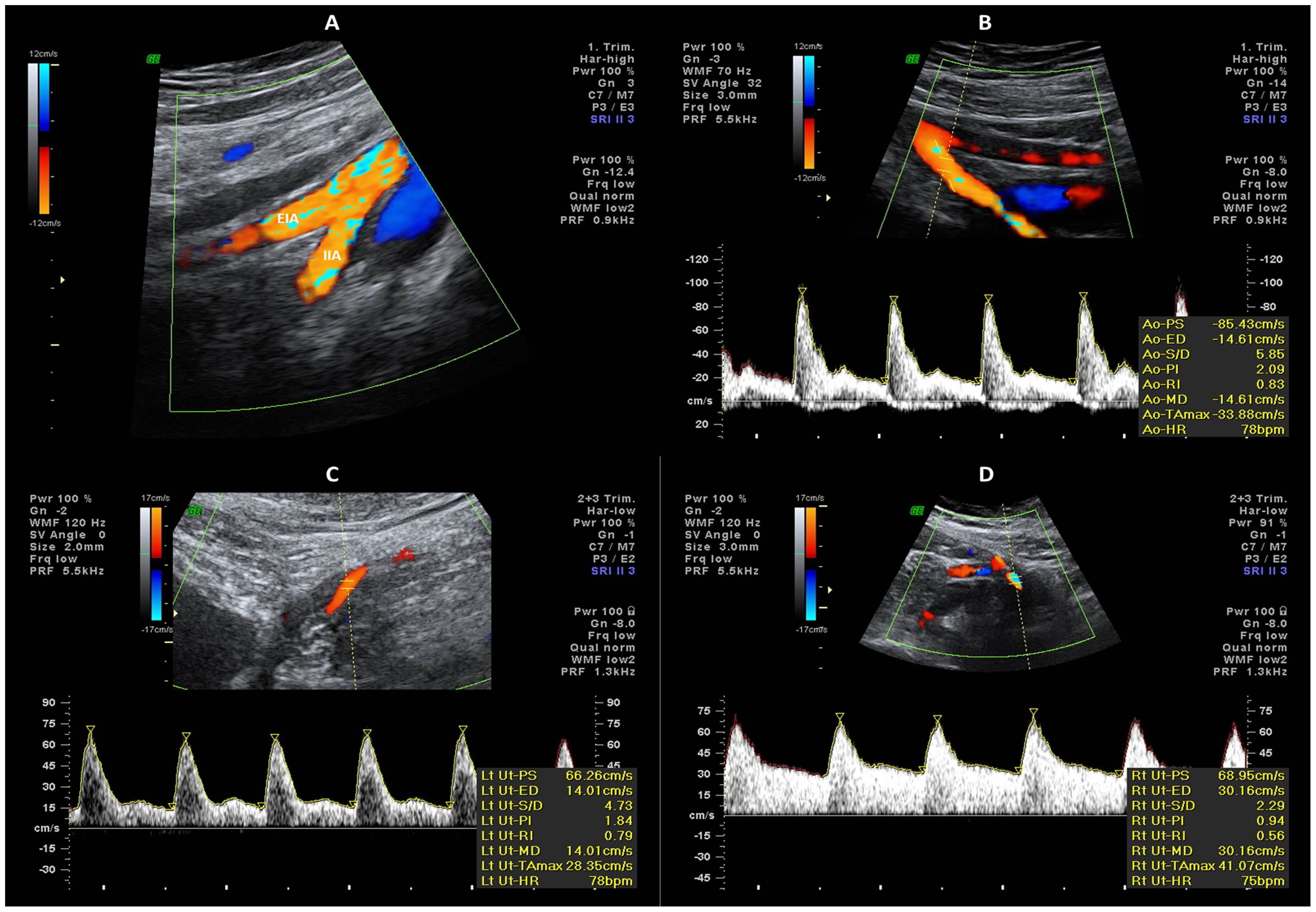 Internal iliac and uterine arteries Doppler ultrasound in the assessment of  normotensive and chronic hypertensive pregnant women | Scientific Reports