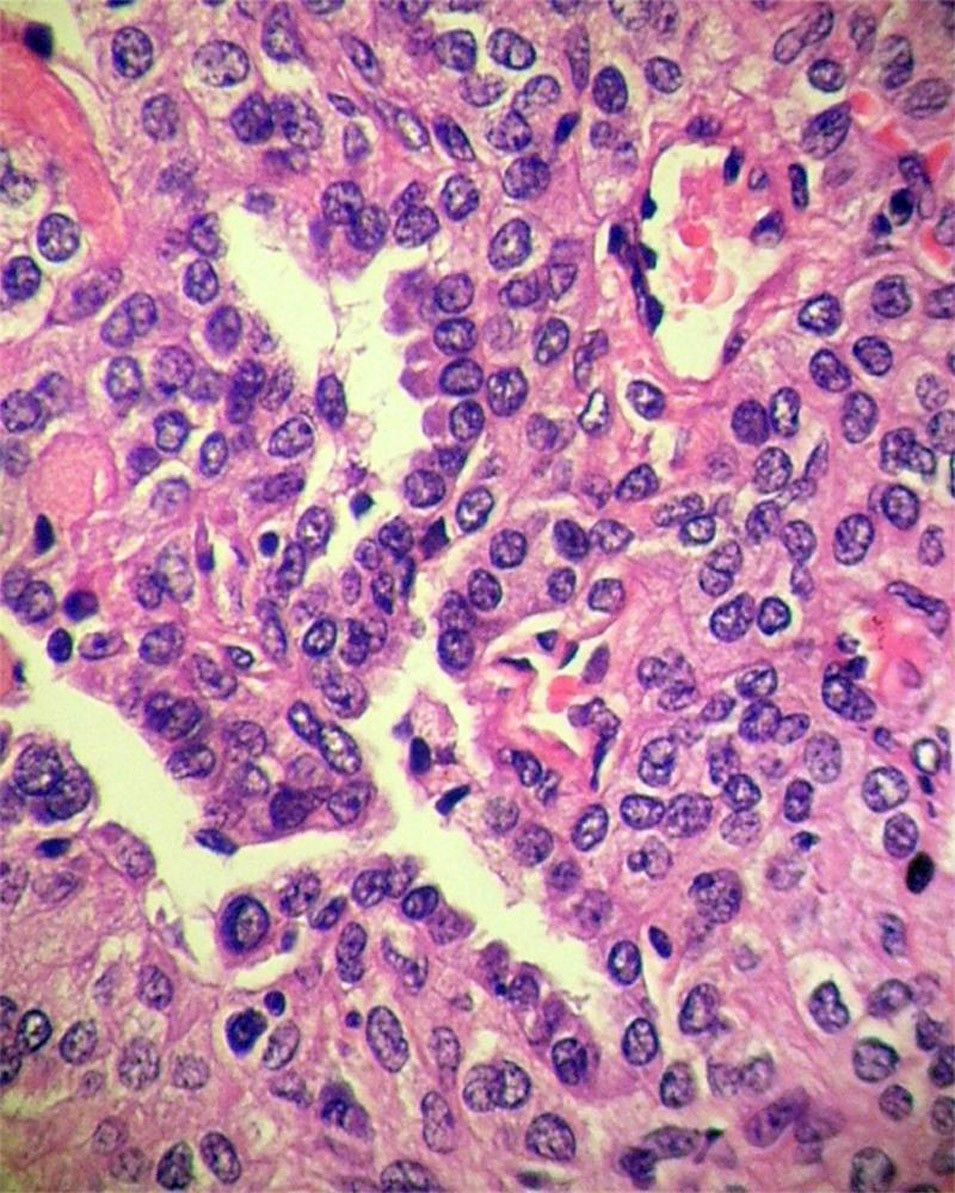 The significance of p40 expression in sclerosing hemangioma of lung |  Scientific Reports