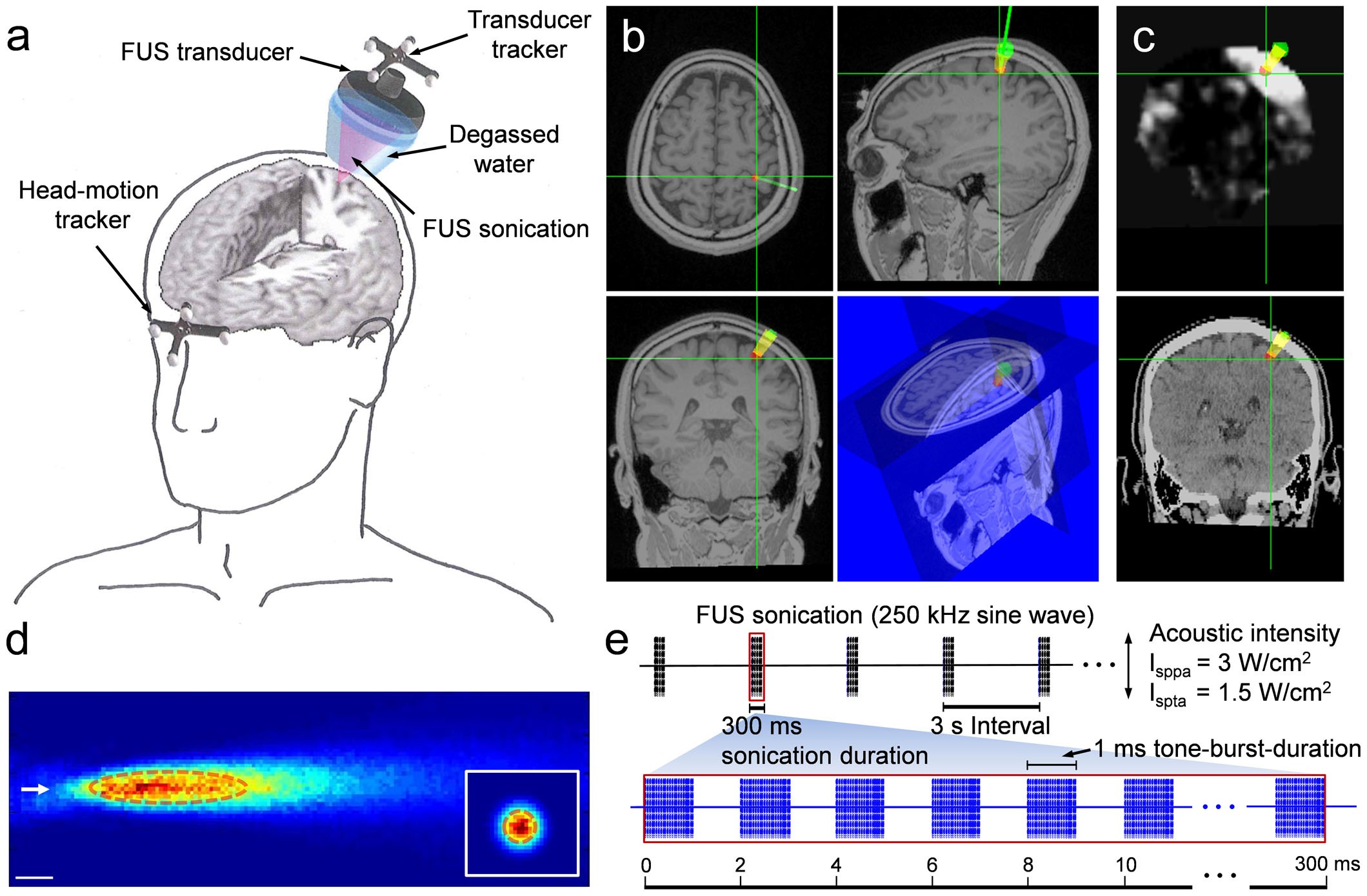 Frontiers  Ulnar Neuropathy at the Elbow: From Ultrasound Scanning to  Treatment