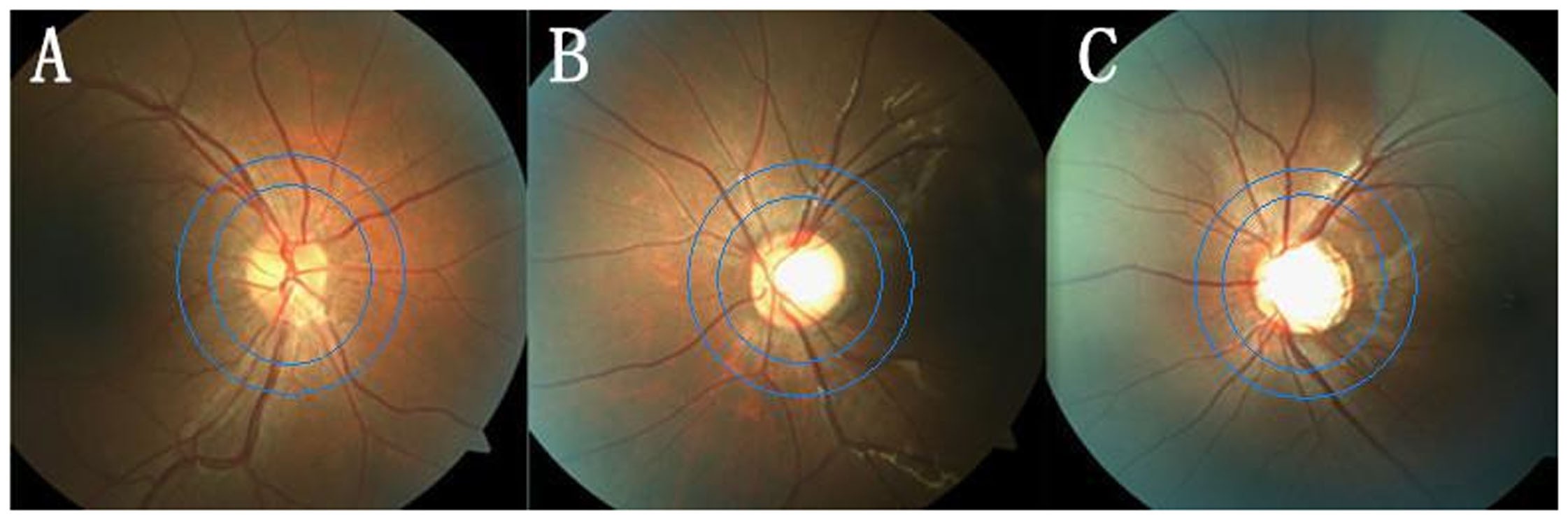 Retinal Vessels Change in Primary Angle-Closure Glaucoma: The Handan Eye  Study | Scientific Reports