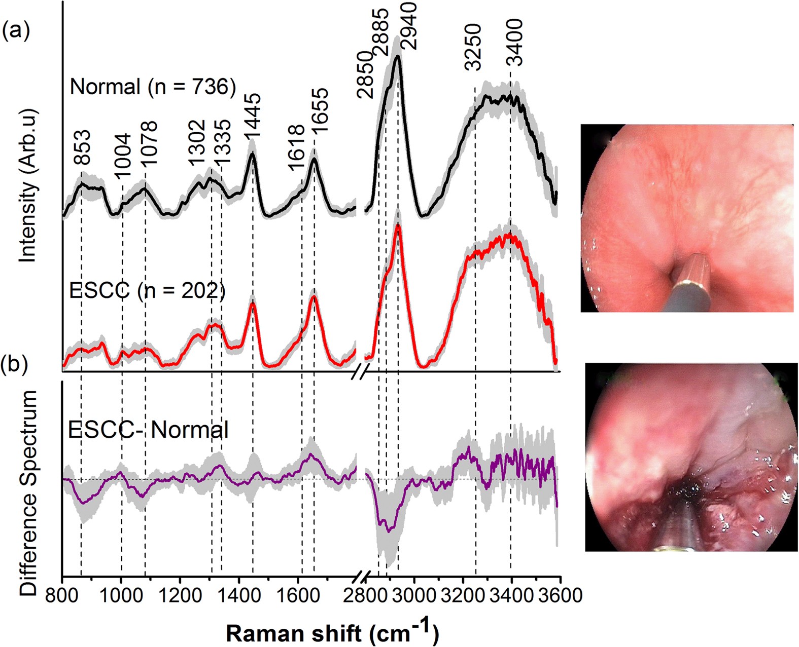 Simultaneous fingerprint and high-wavenumber fiber-optic Raman spectroscopy  improves in vivo diagnosis of esophageal squamous cell carcinoma at  endoscopy | Scientific Reports