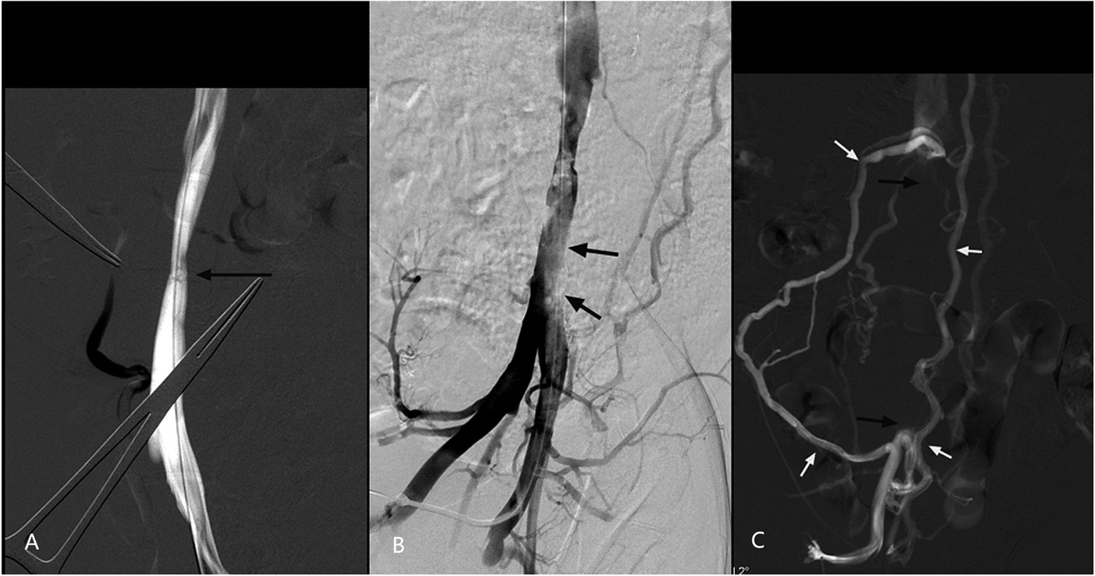 venogram venous occlusive disease