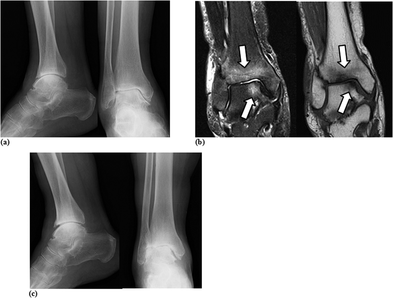 Bone alterations are associated with ankle osteoarthritis joint pain |  Scientific Reports
