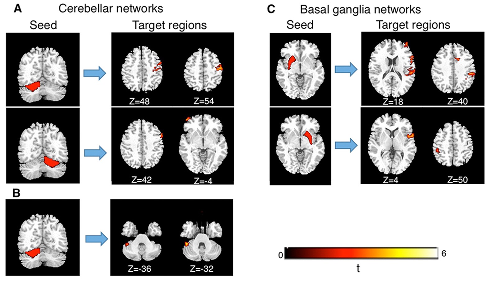 Basal ganglia stuttering - Treatment Options for Stuttering Related to Basal Ganglia