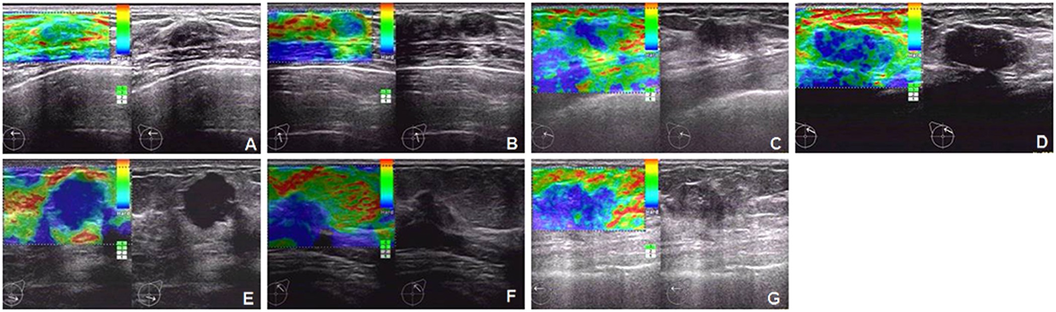 Utility of B-Mode, Color Doppler and Elastography in the Diagnosis