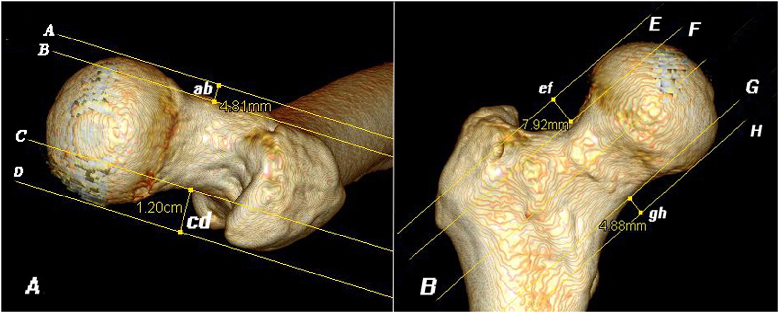 Investigation of association between hip morphology and prevalence of  osteoarthritis | Scientific Reports