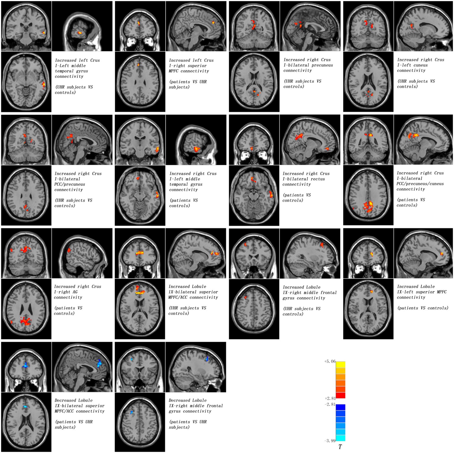 Halting Schizophrenia Before It Starts >> Patients With First Episode Drug Naive Schizophrenia And Halting Schizophrenia Before It Starts >> Patients With First Episode Drug Naive Schizophrenia And