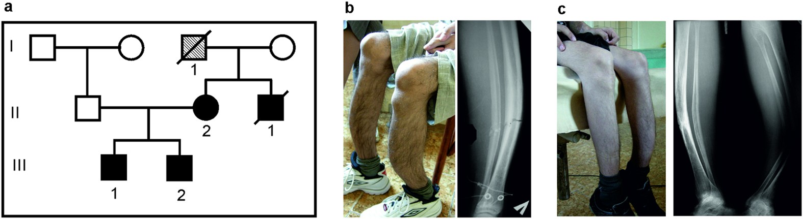 PDF) Identification of de novo EP300 and PLAU variants in a patient with  Rubinstein–Taybi syndrome-related arterial vasculopathy and skeletal anomaly