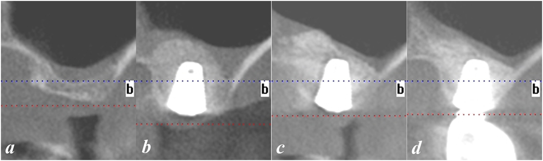 Inlay osteotome sinus floor elevation with concentrated growth factor  application and simultaneous short implant placement in severely atrophic  maxilla | Scientific Reports
