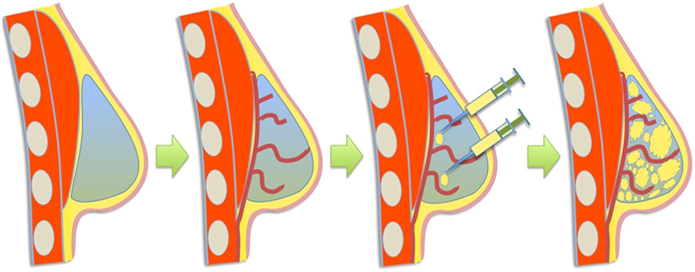 Transformation of Breast Reconstruction via Additive Biomanufacturing | Scientific Reports