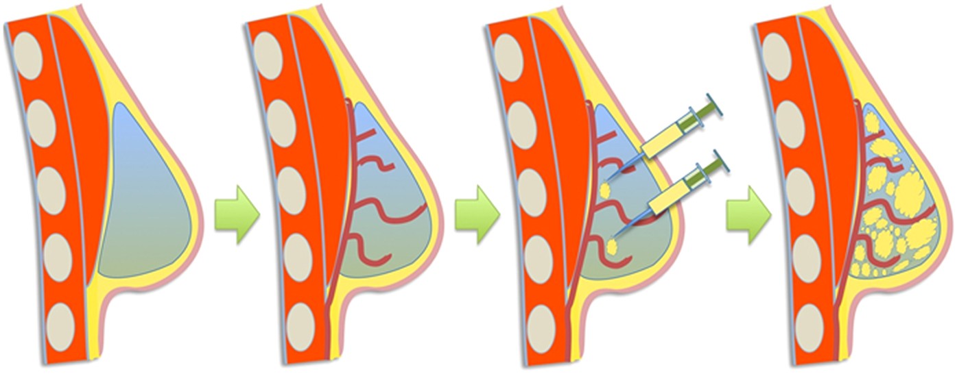 Transformation of Breast Reconstruction via Additive Biomanufacturing