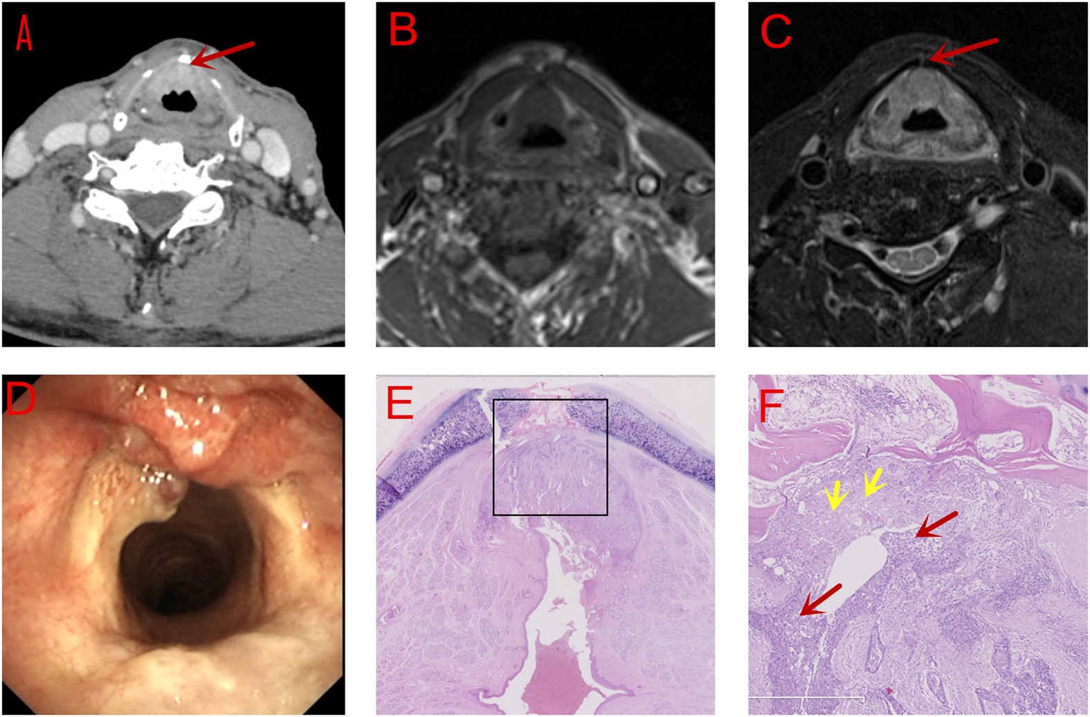 Comparison of CT and MRI in Diagnosis of Laryngeal Carcinoma with Anterior  Vocal Commissure Involvement | Scientific Reports