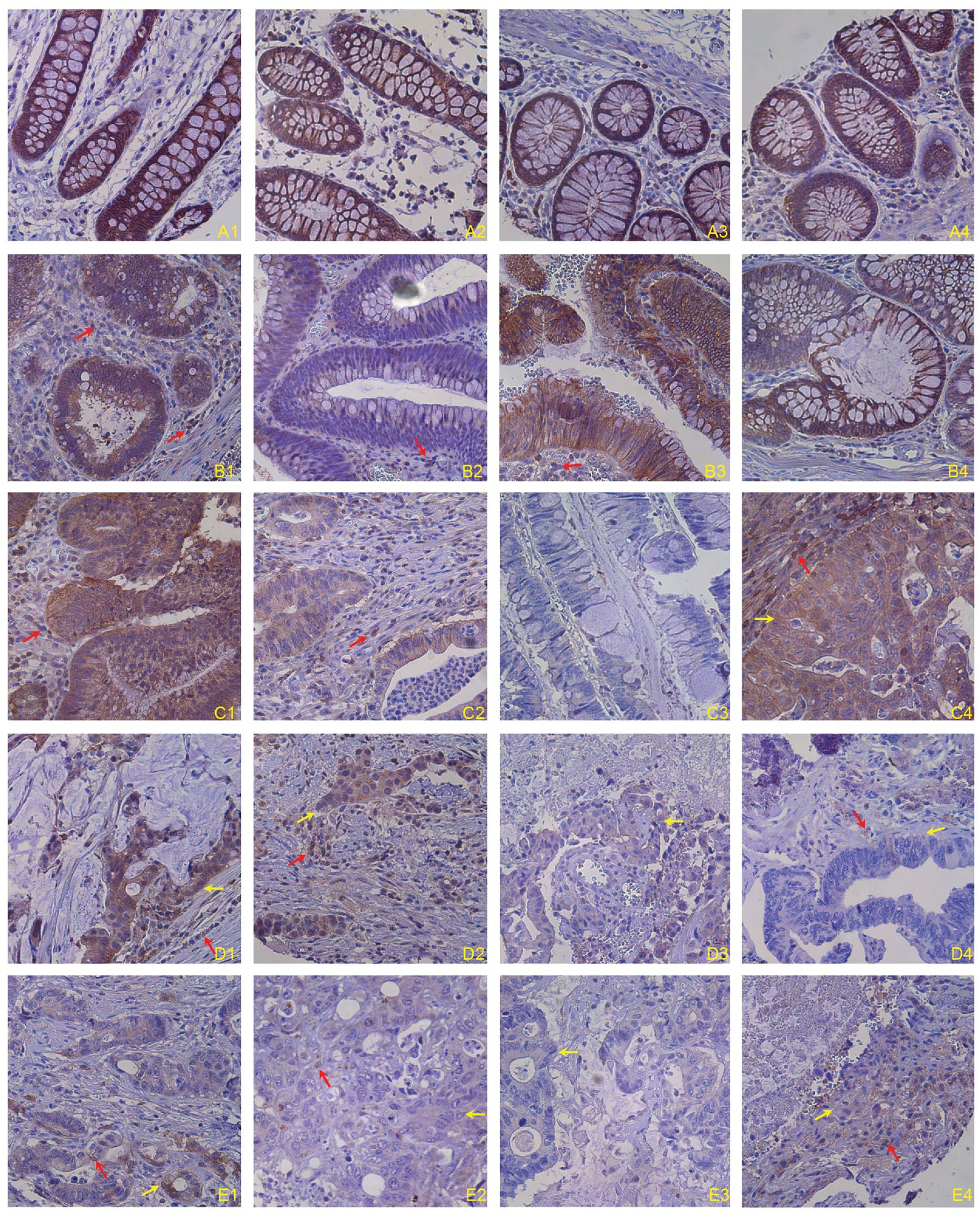 Ceramide Mediates Fasl Induced Caspase 8 Activation In Colon Ceramide Mediates Fasl Induced Caspase