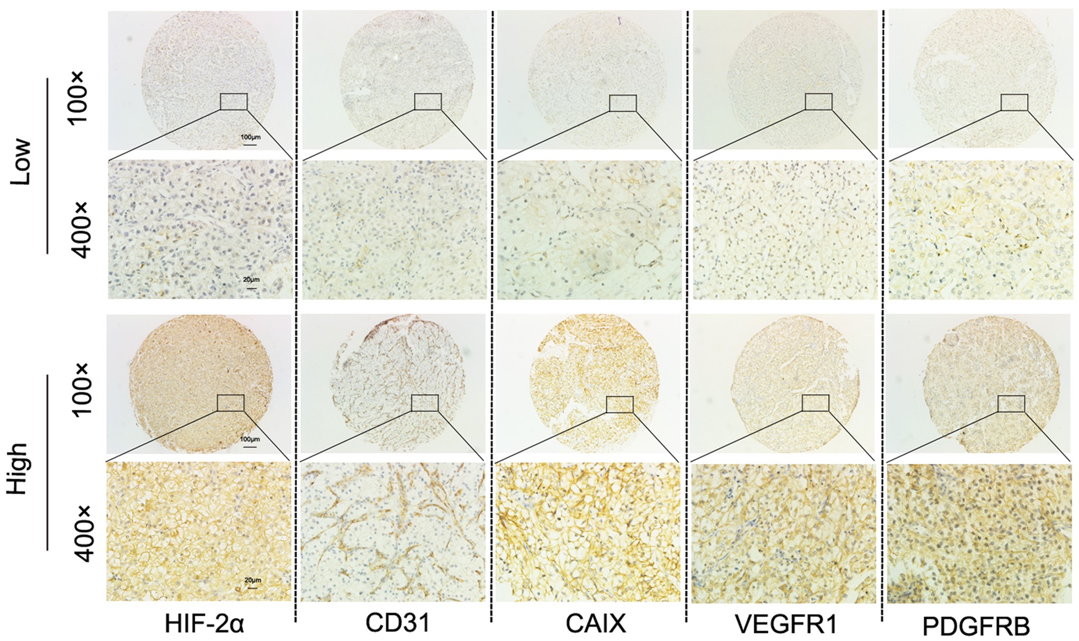 Predictive Immunohistochemical Markers Related To Selection Predictive Immunohistochemical Markers