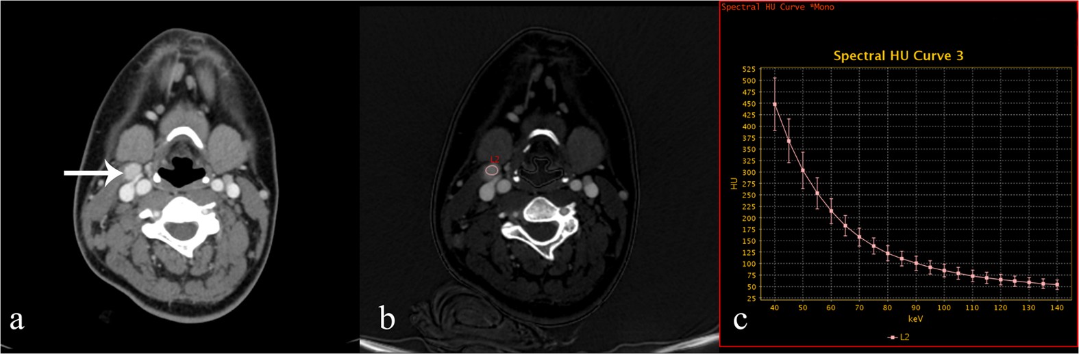 Differentiation Of Malignant Cervical Lymphadenopathy By Dual Energy Ct A Preliminary Analysis Scientific Reports