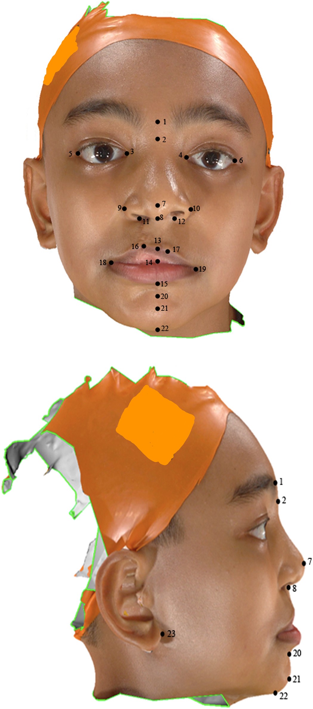 Three-dimensional facial analysis of Chinese children with repaired  unilateral cleft lip and palate | Scientific Reports