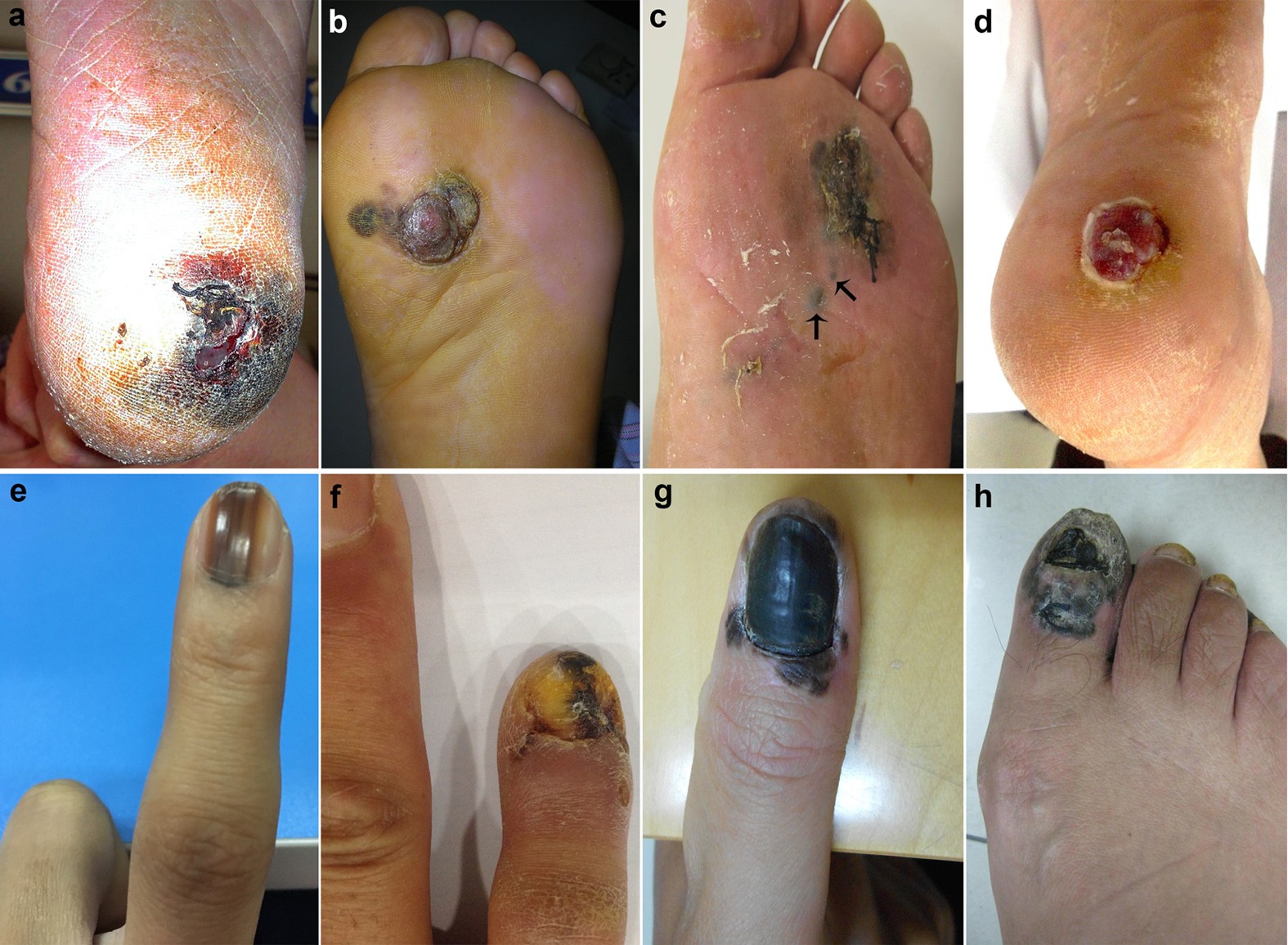 Predictive scoring model for subungual melanoma in situ