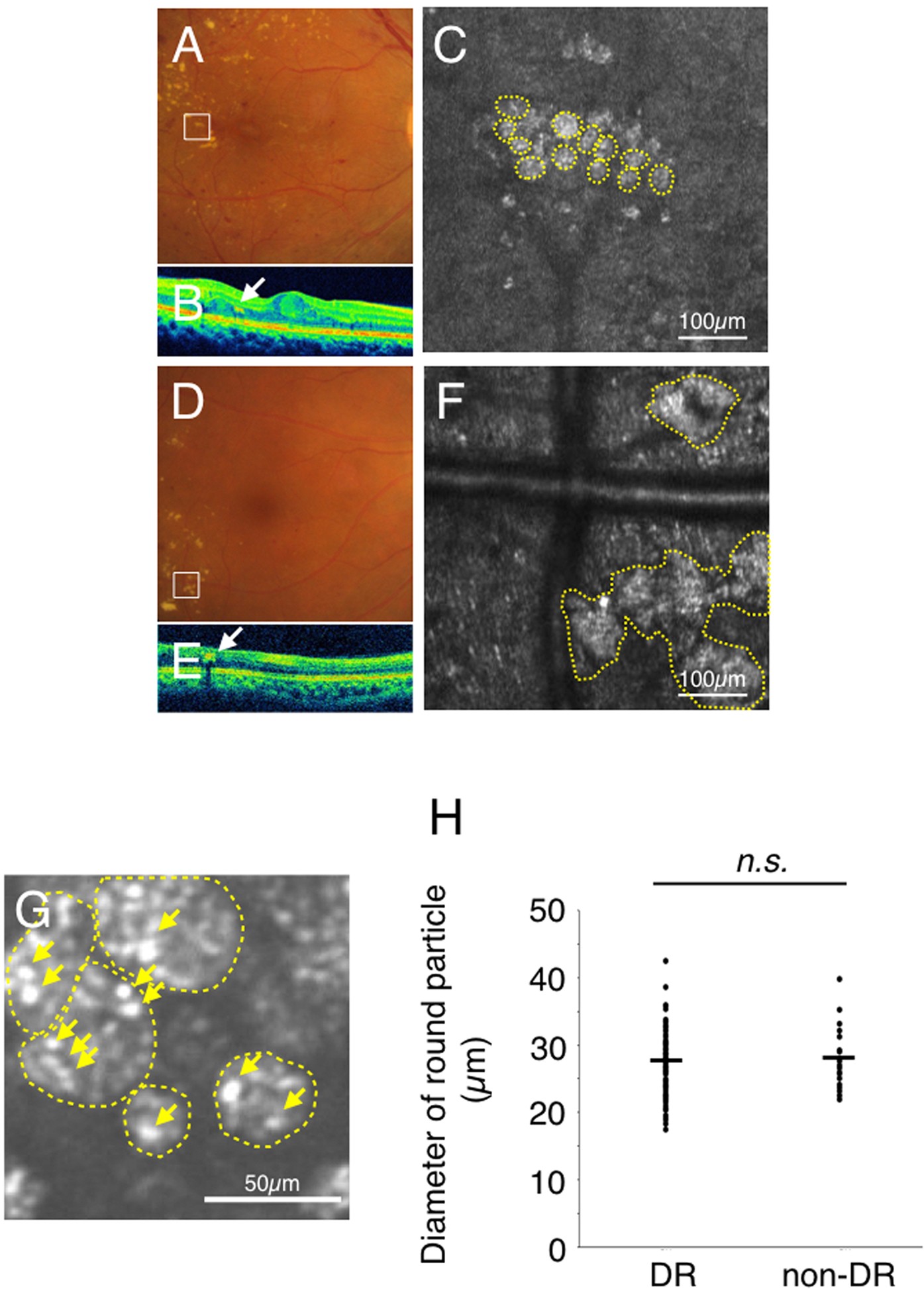 High-Resolution Imaging by Adaptive Optics Scanning Laser Ophthalmoscopy  Reveals Two Morphologically Distinct Types of Retinal Hard Exudates |  Scientific Reports