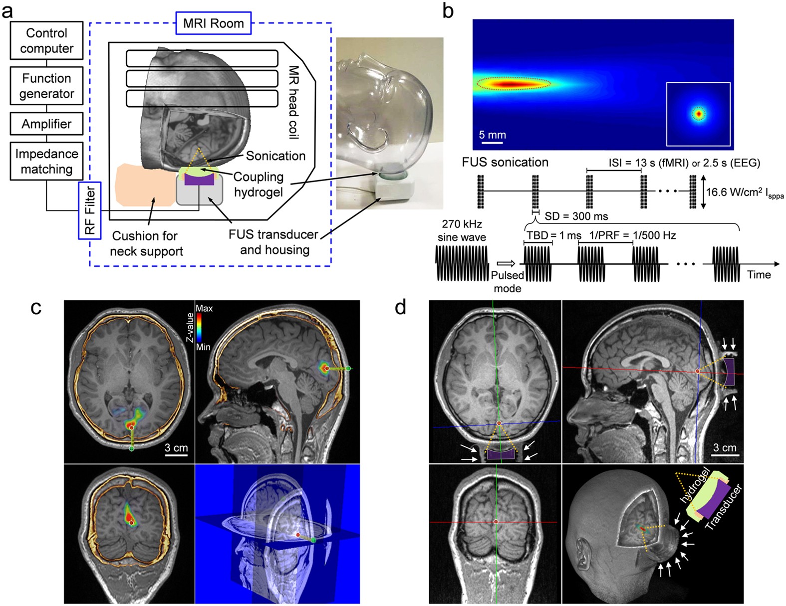 How wearing a cast affects sense of touch and brain activity